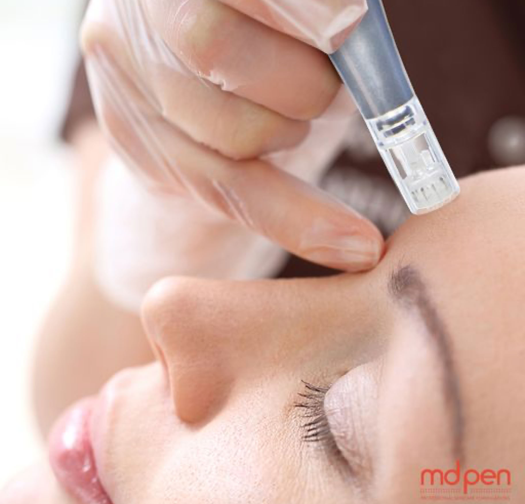 Professional microneedling treatment designed to support collagen production and improve skin texture and appearance.